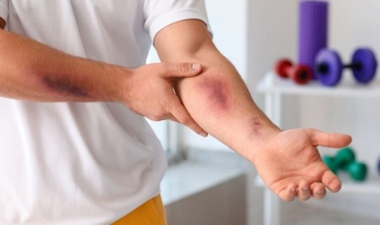 Bunlar vücudunuzdaki ani çürüklerin nedenleriydi: vücuttaki çürükler, ani çürüklerin nedeni nedir? Çürükler için iyi olan nedir? – Yaşam Haberlerini Kırma