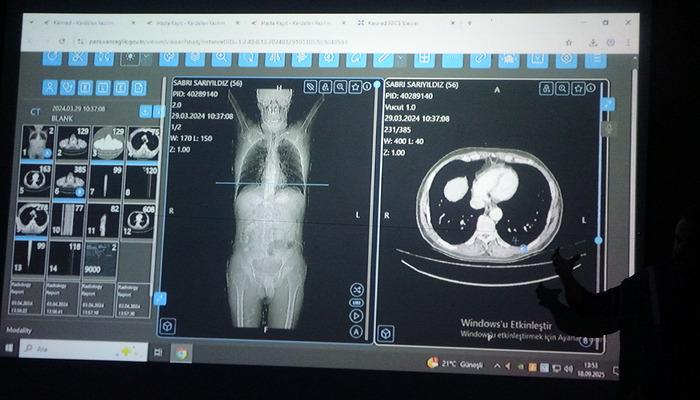 Dünya için bir örnekti! Türkiye’de birincisi: Kanser tedavisinde yapay zeka kullanıldı