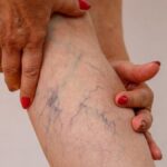 Varichosel nedir, işaretler nedir? Varikosel tedavisi nasıl yapılır?